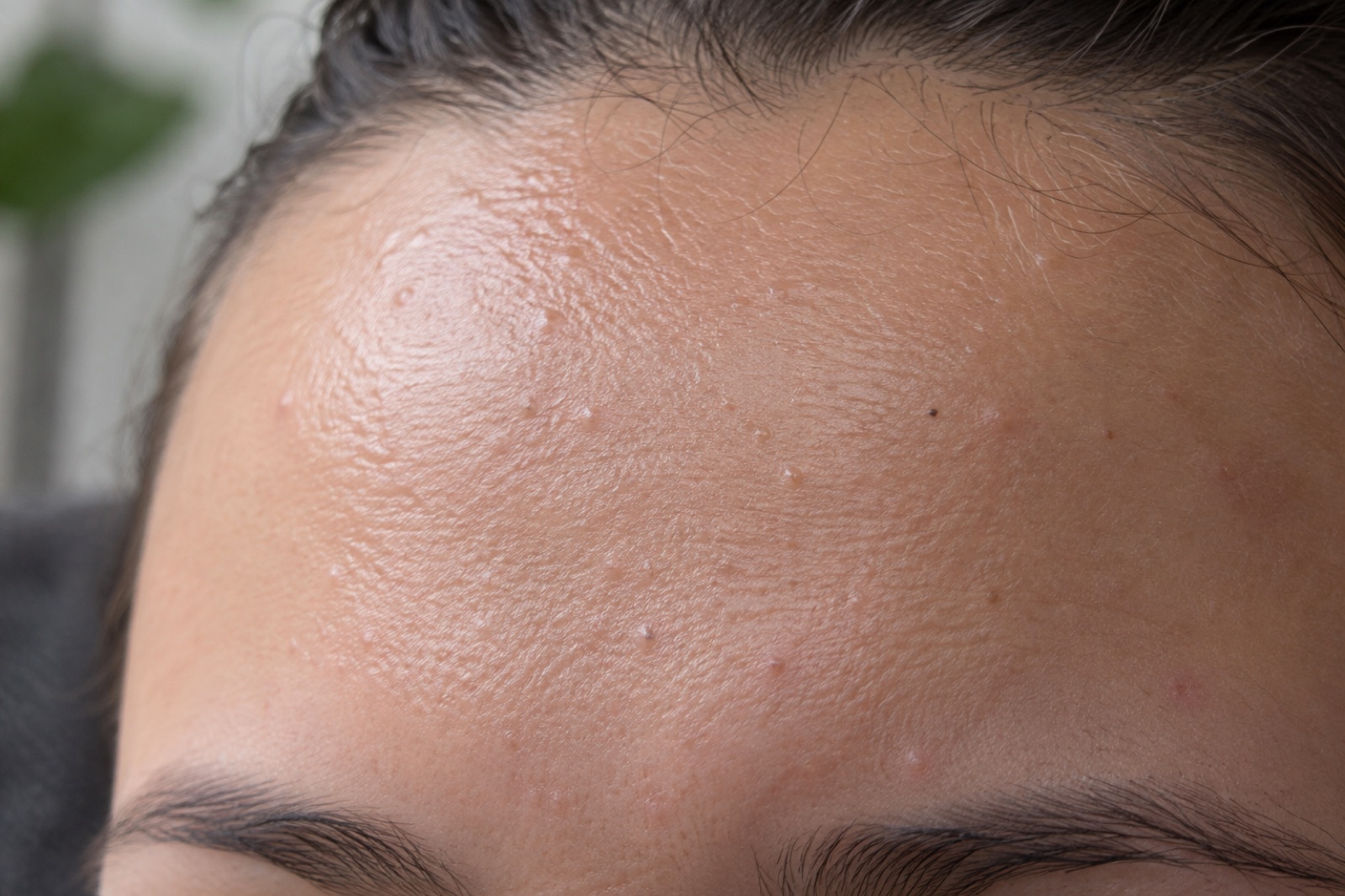 Close-up of a shiny forehead under the hairline, scattered with small skin-colored and white grains