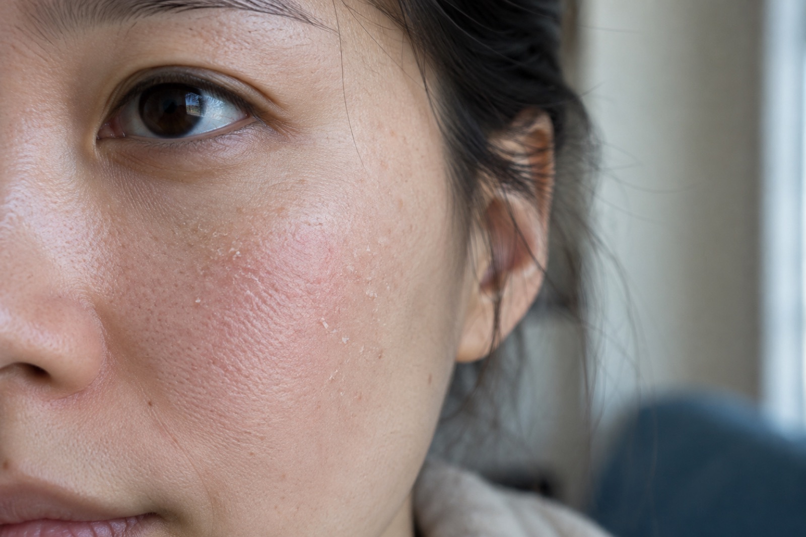 눈 아래 볼에 하얀 각질 조각이 일어나고 살짝 붉은 기가 도는 얼굴 옆부분 근접 사진
