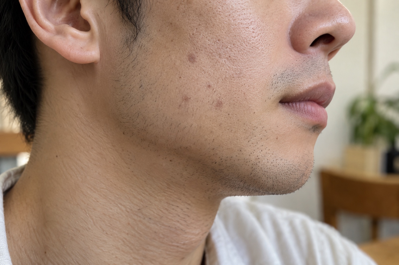 Malapitang kuha mula sa gilid ng lalaking may maikling balbas, may tatlo o apat na mapusyaw na brown at pinkish na bilog na marka sa pisngi sa ilalim ng cheekbone