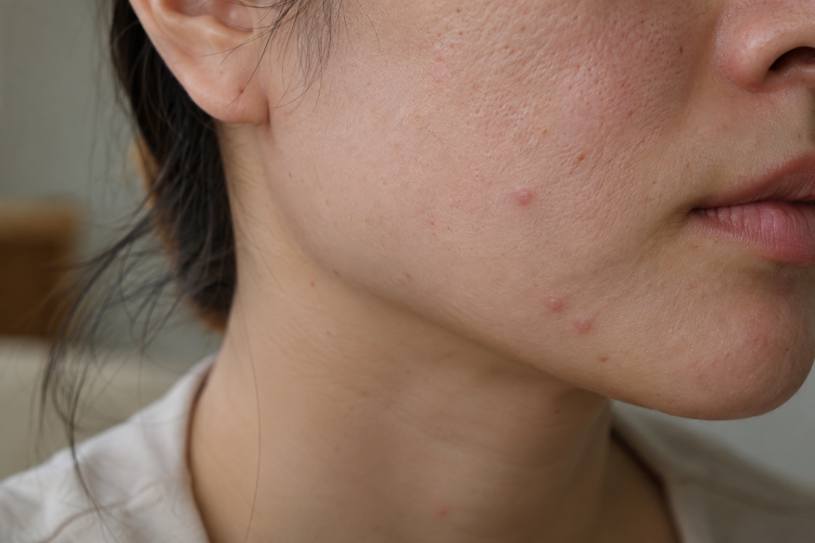 ใบหน้าด้านข้างระยะใกล้ของผู้หญิงตั้งแต่ใต้หูถึงมุมปาก มีตุ่มสีชมพูนูนเล็กน้อยสามสี่ตุ่มตามขอบกราม
